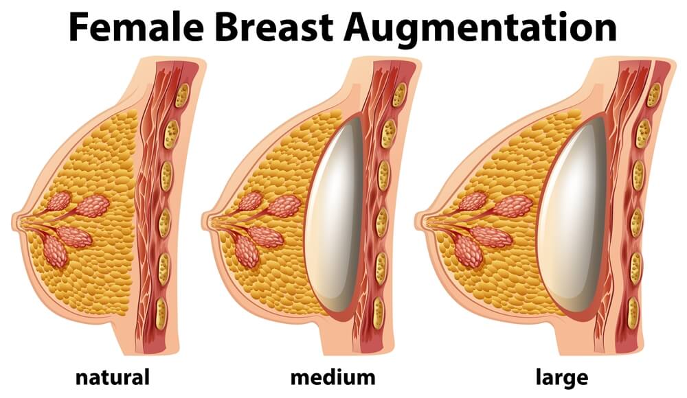 800cc Implants