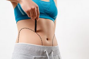 Liposuction Procedure