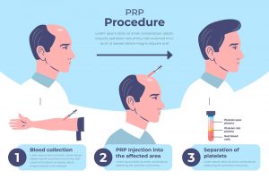 Platelet Rich Plasma