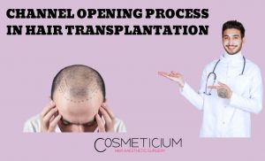 Why Is The Channel Opening Process So Significant In Hair Transplantation?