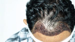 Bandage Day After the Hair Transplantation