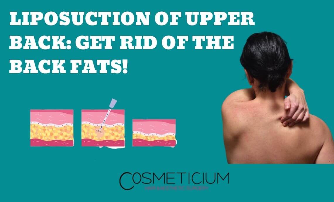 Liposuction of Upper Back: Get Rid Of The Back Fats!