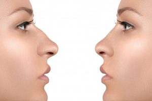 Functional Rhinoplasty Procedure