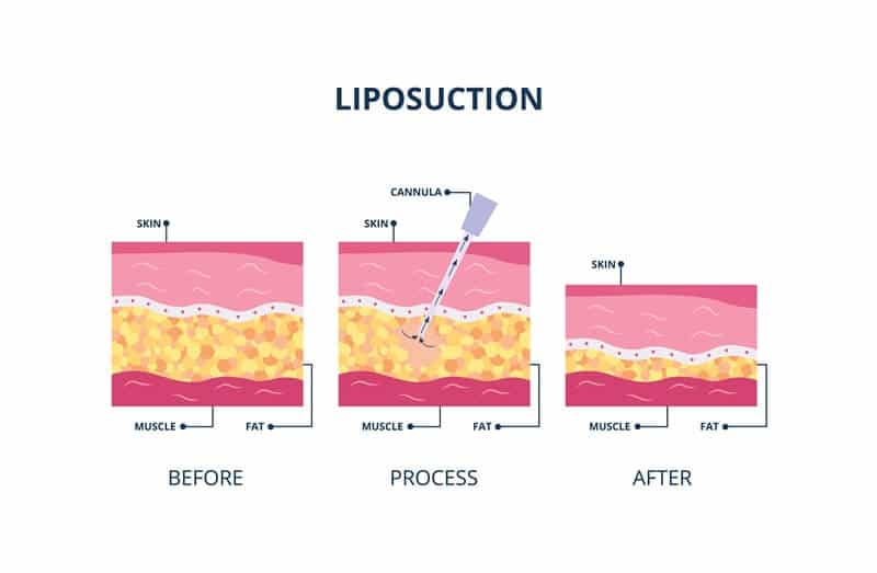 Liposuction and Gastric Bypass
