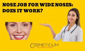 Rhinoplasty for Wide Noses