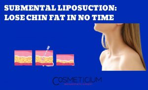 Submental Liposuction in Turkey