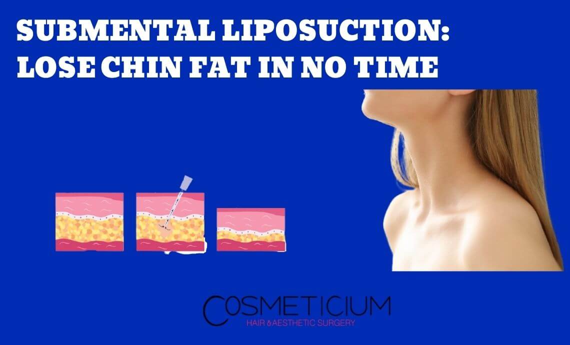 Submental Liposuction: Lose Chin Fat in No Time