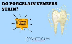 Dental Veneers