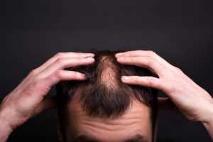How Long Does Hair Loss Take?