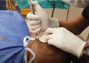 Painless and Needle-Free Hair Transplant at Cosmeticium