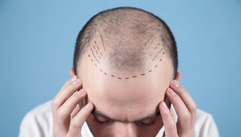 For How Long Does Permanence of Hair Transplant Continue?