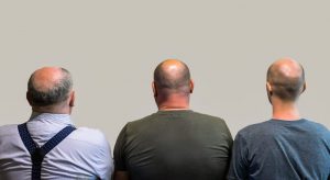 Biotin Deficiency and Hair Loss