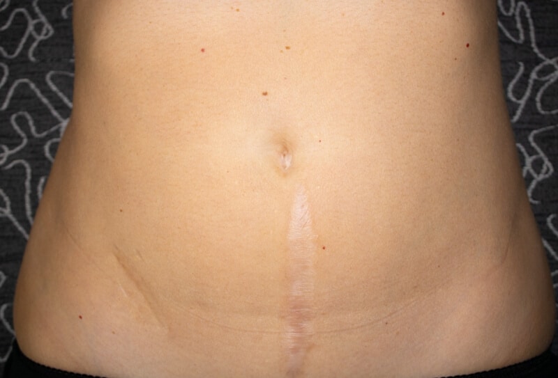 Vertical Tummy Tuck Scars