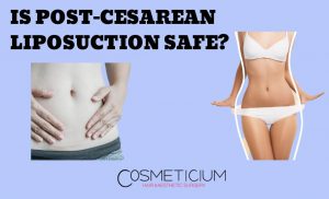 Liposuction after cesarean