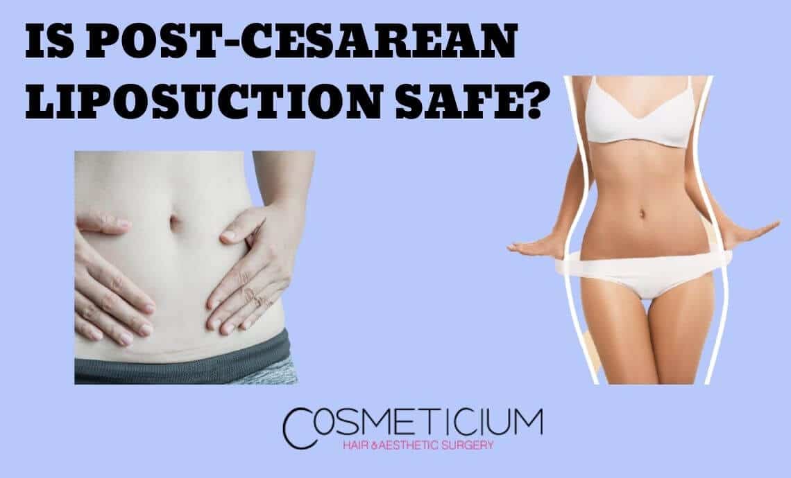 Is Post-Cesarean Liposuction Safe? How Long Should One Wait?