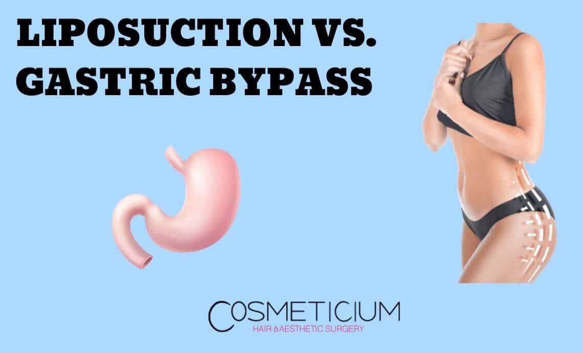 Liposuction vs. Gastric Bypass: Which One Is Right for You
