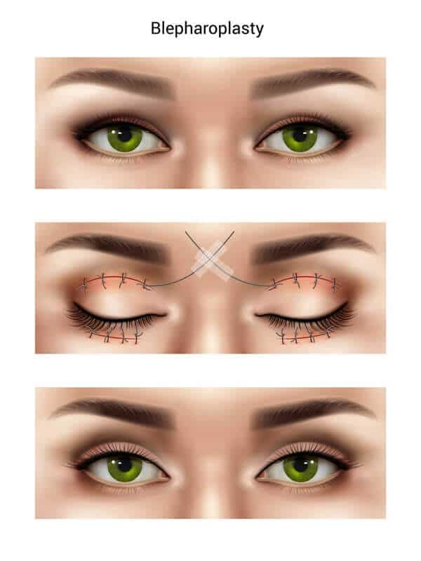 In Which Situation Is Eyelid Surgery Better Than Botox?