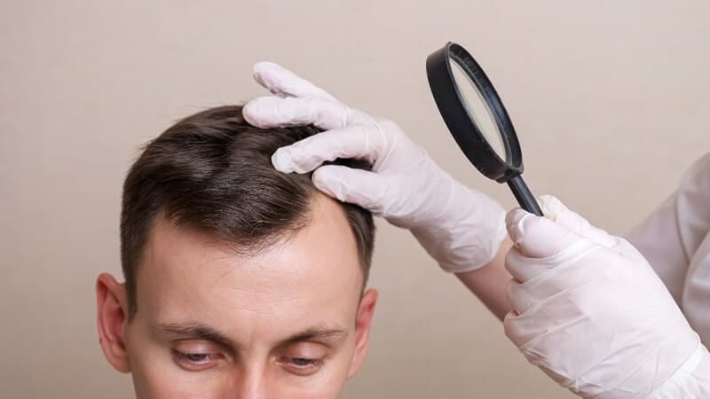 Symptoms of Early Baldness