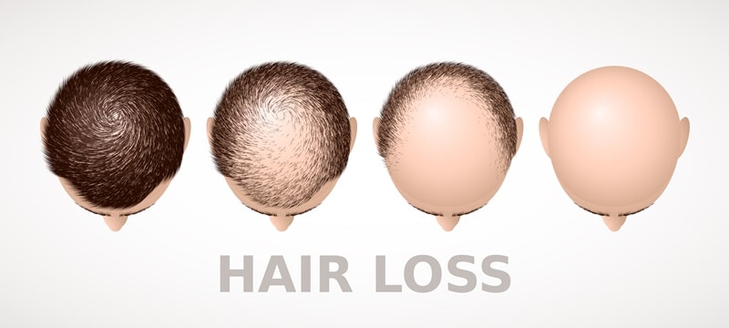 The risk of hair loss due to clogged pores
