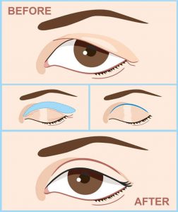Eyelid Surgery Before and After