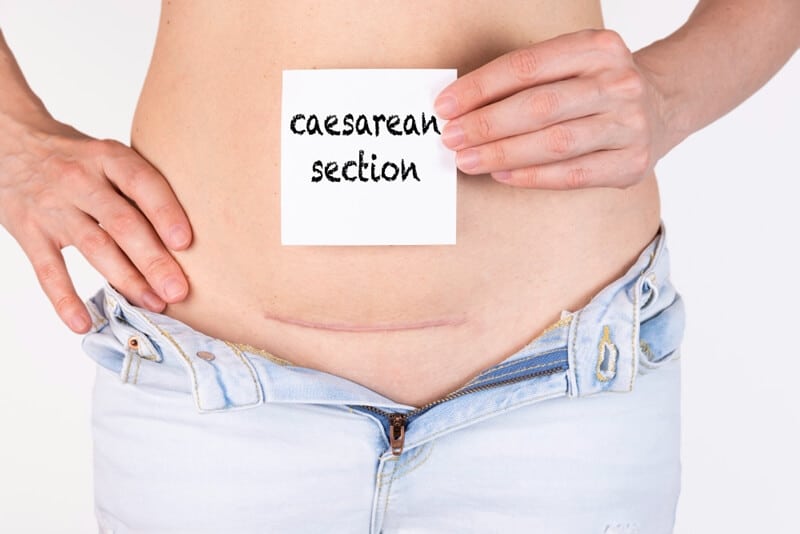 Liposuction After Cesarean