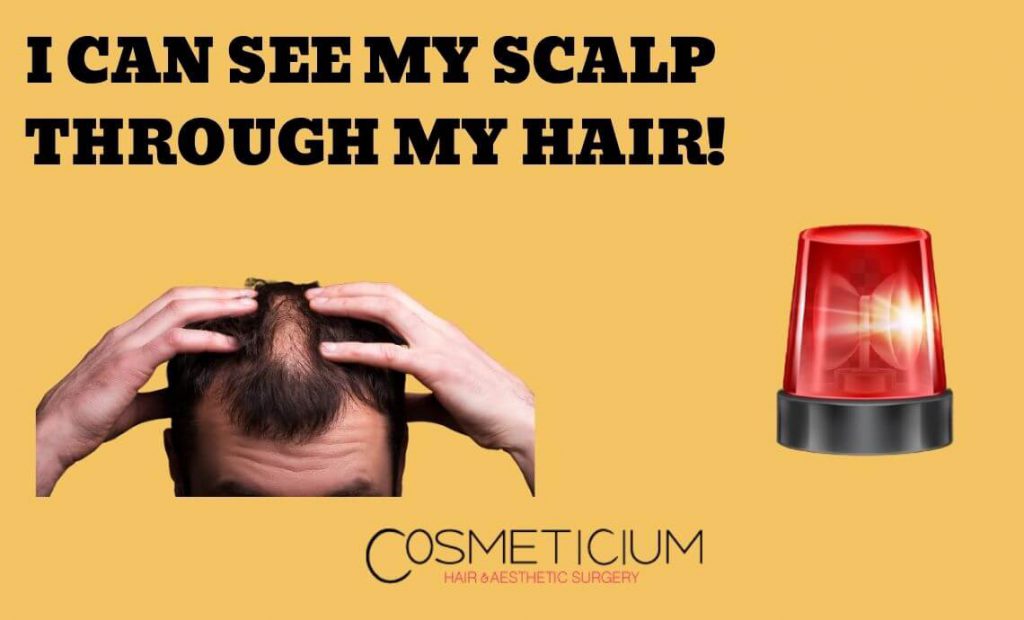 I Can See My Scalp Through My Hair! Will I Be Completely Bald?