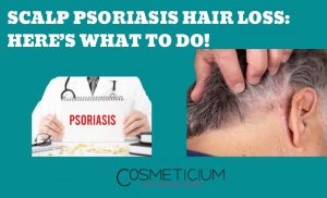 Scalp Psoriasis Hair Loss