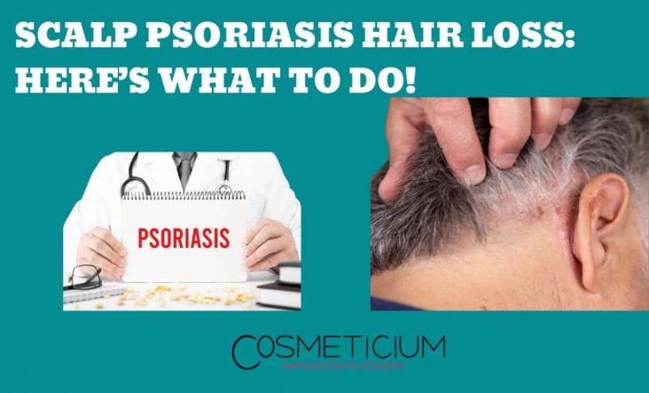 Scalp Psoriasis Hair Loss: Here’s What to Do! - Cosmeticium