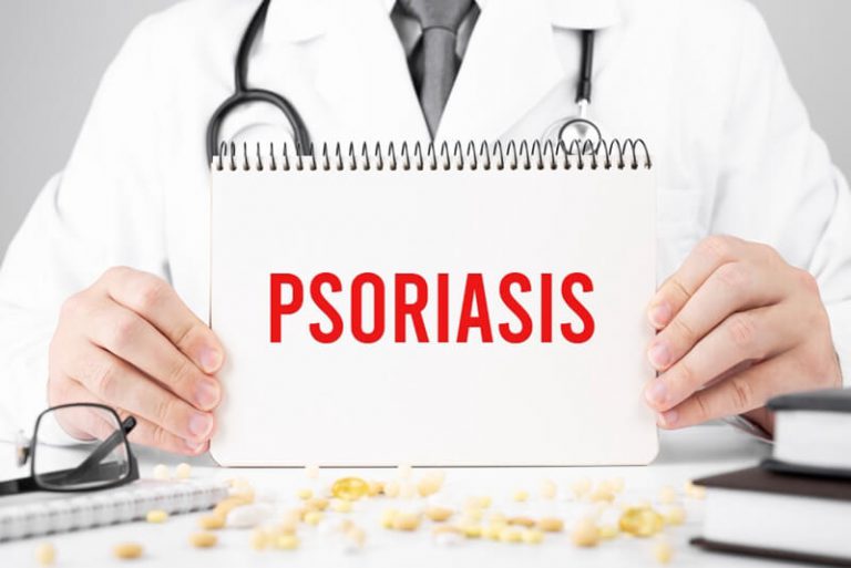 Scalp Psoriasis Hair Loss: Here’s What to Do! - Cosmeticium