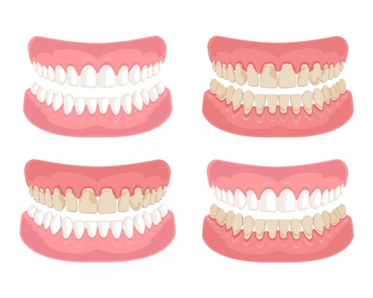 Remove Smoking Stains on Teeth The Most Effective Solutions!