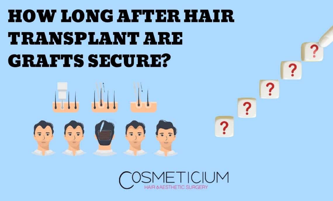 How Long After Hair Transplant Are Grafts Secure?