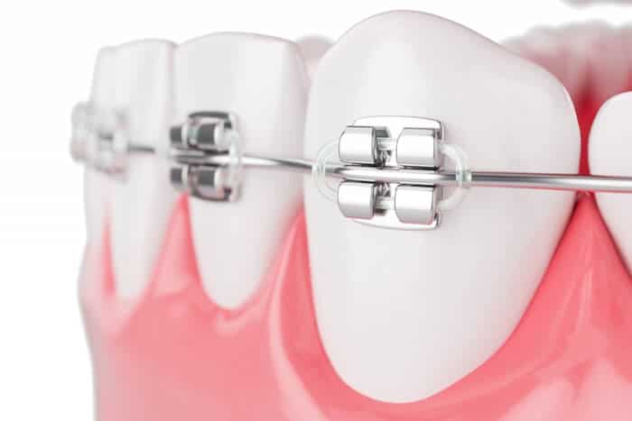 Crooked Teeth Treatment Without Braces