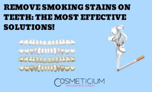 Smoking Stains on Teeth