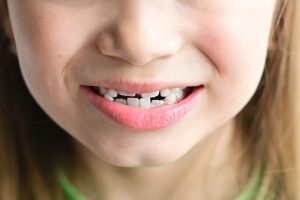 Crooked Teeth Girl