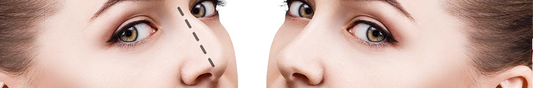 rhinoplasty surgery