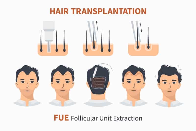 What Kind Of Procedure Is Applied With Grafts During Hair Transplantation?