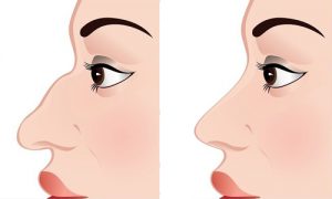 Steps of Rhinoplasty Surgery