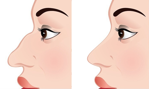 Steps of Rhinoplasty Surgery