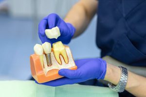 Is It Really Necessary to Put Crowns on Baby Teeth?