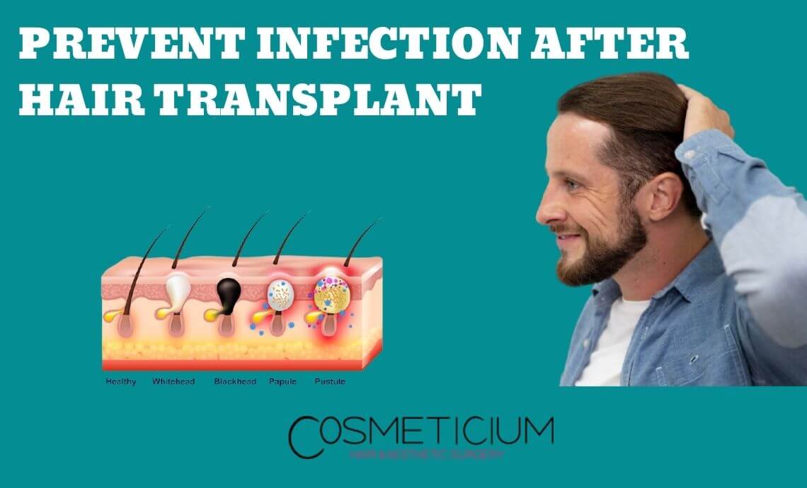 Prevent Infection After Hair Transplant – Here’s What to Do!