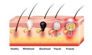 How Does Infection Occur?