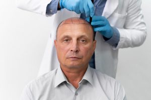 Synthetic Hair Transplant