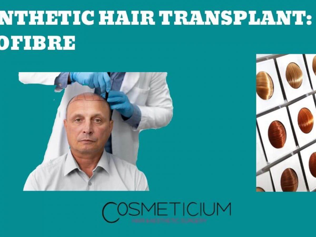 Hair Transplant 10 Years After Operation  MyCapil 
