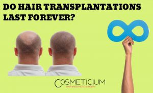 Does hair transplant last forever?