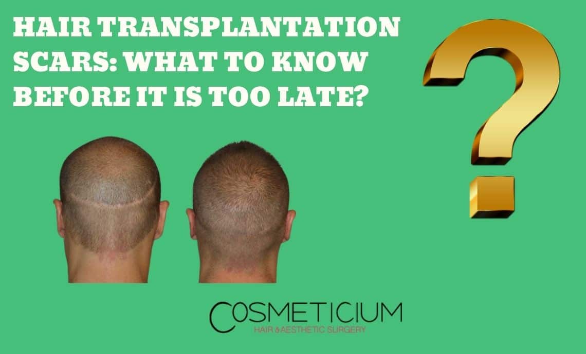 Hair Transplantation Scars: What to Know Before It Is Too Late?