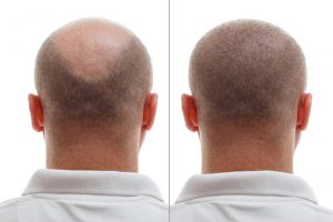 Hair Transplantation in Turkey