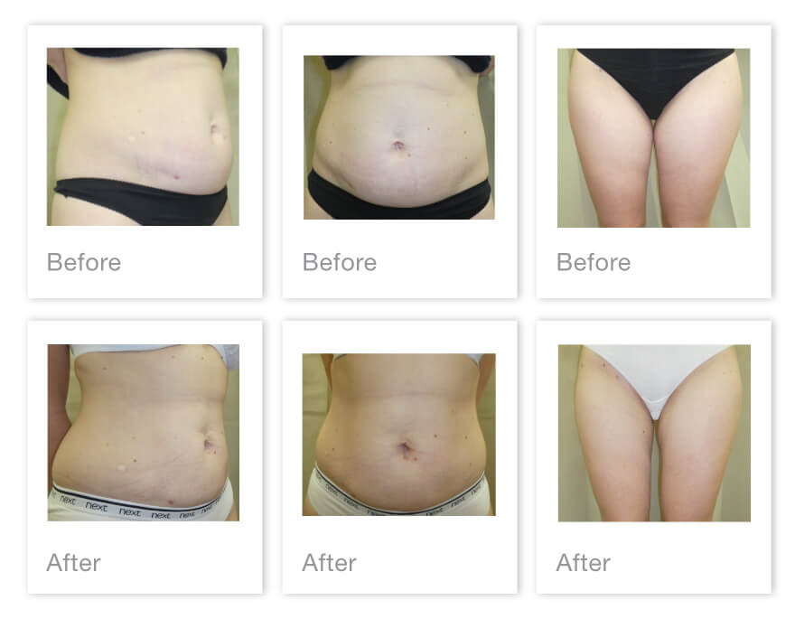 Liposuction-Before-After-Surgery-Result 2021