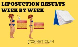 Liposuction Results
