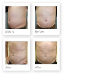 Liposuction-procedure-June-2018-Exeter