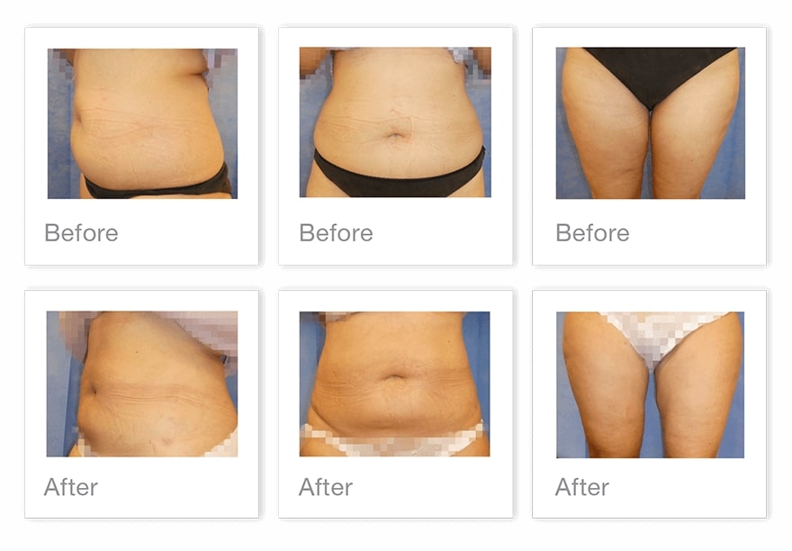 Liposuction-surgery-before-After-with-October-2022